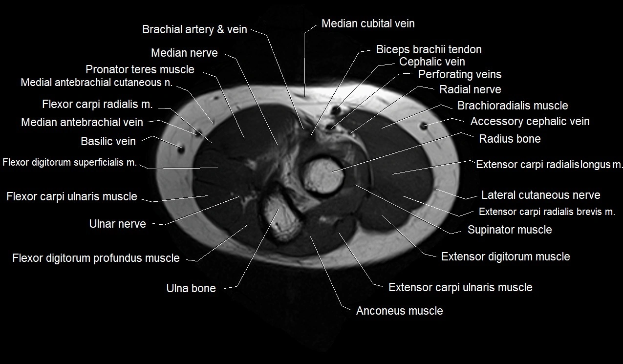 MRI 3T forearm axial cross sectional anatomy image 10.webp